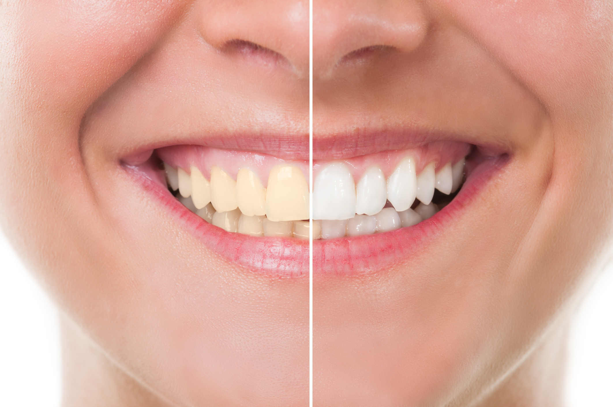 Teeth Whitening What is it and how does it work? St John GP, Urgent Care & Dental